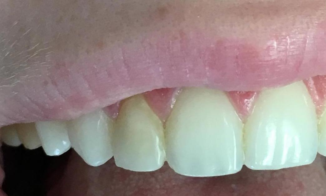Tooth Colored Fillings | Workman Family Dental
