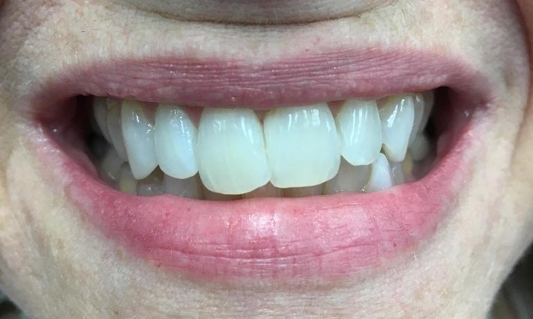 Dental Bonding | Workman Family Dental