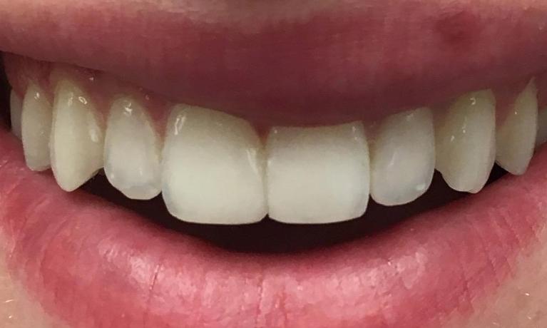 Emergency-Dentistry-Broken-Tooth-Fixed-Using-Tooth-Colored-Filling-After-Image