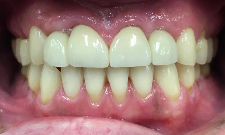 Porcelain-Crowns-After-Image