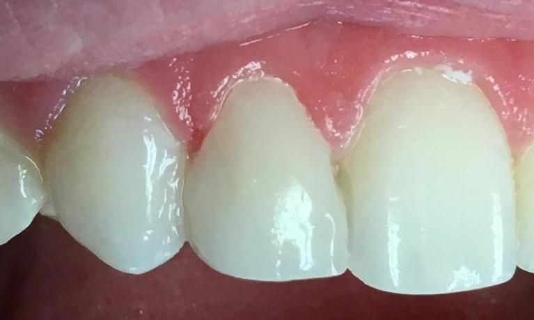 Tooth-Colored-Filling-to-Match-Other-Teeth-Cosmetic-Dentistry-After-Image