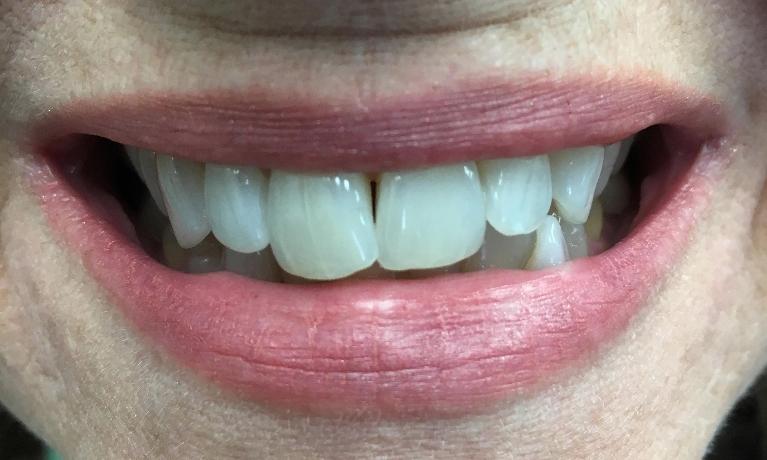 Dental Bonding | Workman Family Dental