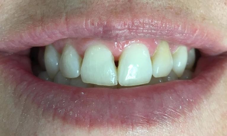 Cosmetic Dentistry | Workman Family Dental