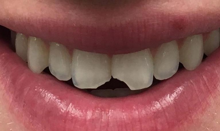 Emergency-Dentistry-Broken-Tooth-Fixed-Using-Tooth-Colored-Filling-Before-Image