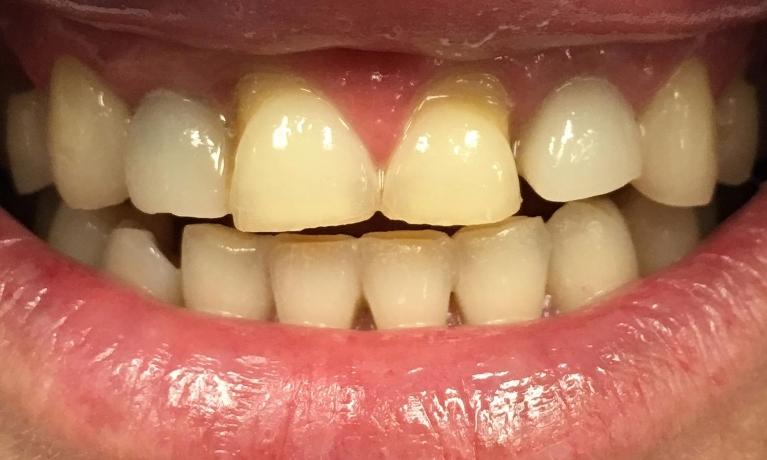 Porcelain-Crowns-Before-Image
